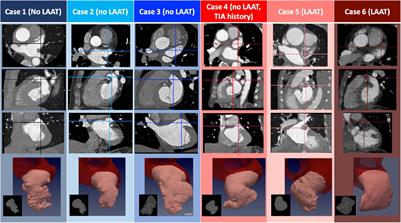 Demonstration of Patient-Specific Simulations to Assess Left Atrial Appendage Thrombogenesis Risk